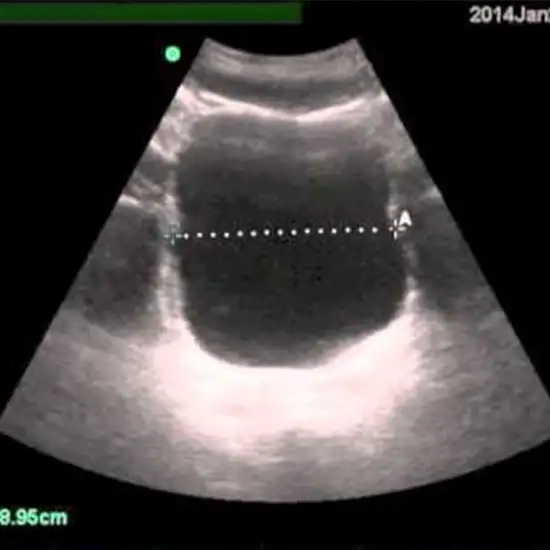 Ultrasound Post Void Residual Test
